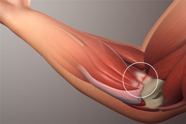 Viêm khớp khuỷu tay và những điều cần biết