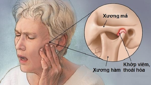 Viêm khớp quai hàm: Nguyên nhân, triệu chứng, cách điều trị