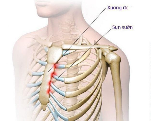 Viêm khớp sụn sườn: Bệnh lý của mọi lứa tuổi