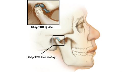 Viêm khớp thái dương hàm và phương pháp điều trị