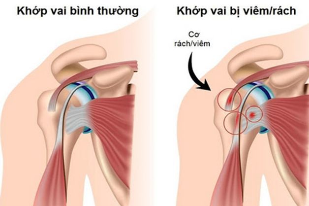 Viêm khớp vai có chữa trị dứt điểm được không?