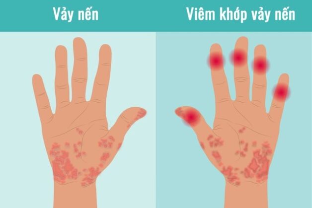 Viêm khớp vẩy nến – bệnh lý nguy hiểm chớ nên chủ quan!