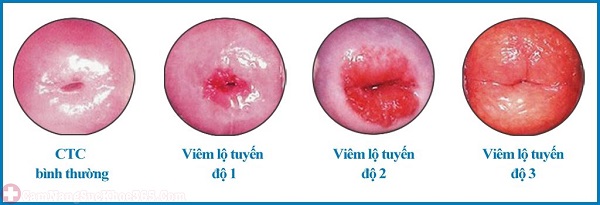 Viêm lộ tuyến cổ tử cung độ 3 và những điều cần biết