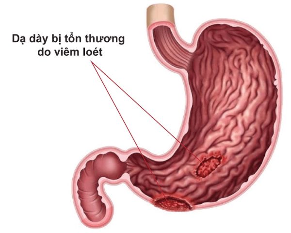 Viêm loét dạ dày có nguy hiểm không? Nên điều trị như thế nào?