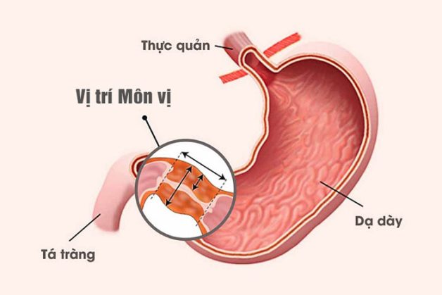 Viêm loét dạ dày có phải mổ không? – Góc giải đáp