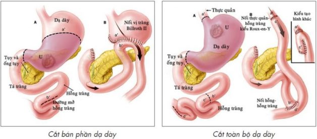 Viêm loét dạ dày có phải mổ không? – Góc giải đáp