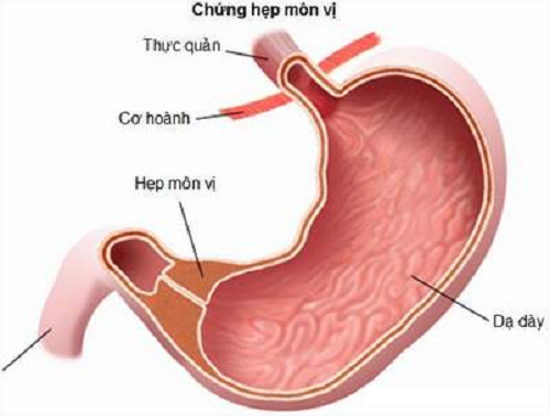 Viêm loét dạ dày nguy hiểm như thế nào?