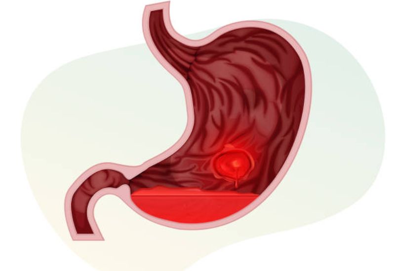 Viêm loét dạ dày ợ chua: Mối liên hệ bệnh lý và triệu chứng