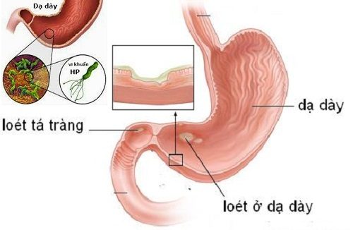 Viêm loét dạ dày tá tràng – những điều cần biết