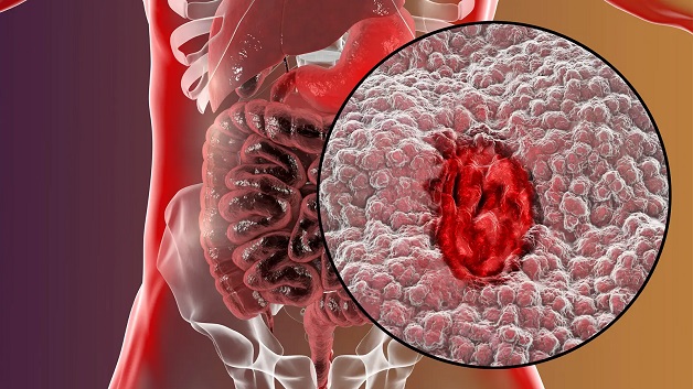 Viêm loét dạ dày: Triệu chứng, chẩn đoán và cách điều trị