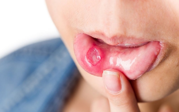 Viêm lợi Herpes và cách điều trị