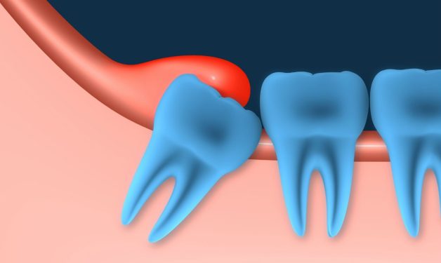 Viêm lợi trùm có mủ: Dấu hiệu và phương pháp điều trị