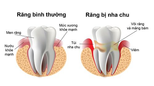 Viêm lợi và viêm nha chu: Phân biệt và cách chữa