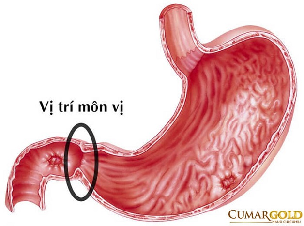 Viêm môn vị dạ dày và những điều cần biết 