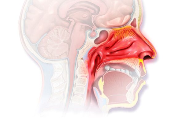 Viêm mũi cấp: Nguyên nhân, dấu hiệu, cách điều trị