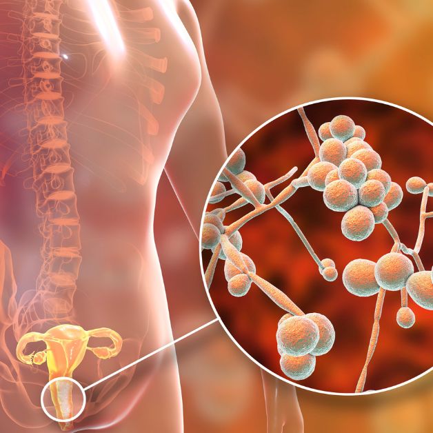 Viêm nấm candida là bệnh gì? Các triệu chứng thường gặp