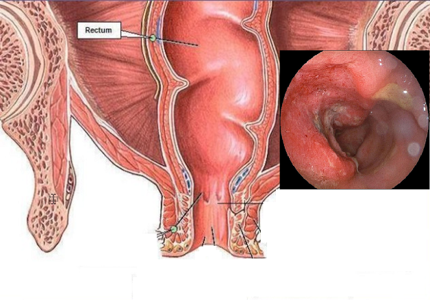 Viêm niêm mạc đại tràng và những điều cần biết