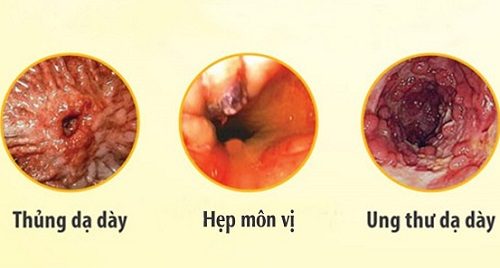 Viêm niêm mạc hang vị dạ dày có nguy hiểm không?