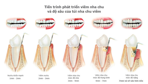 Viêm nướu và bệnh nha chu: Phân biệt và cách chữa