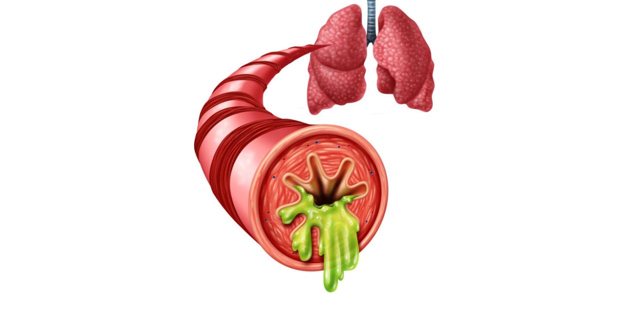 Viêm phế quản cấp ở trẻ em: Chẩn đoán và điều trị