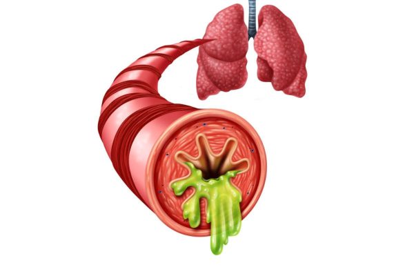 Viêm phế quản cấp ở trẻ em: Chẩn đoán và điều trị