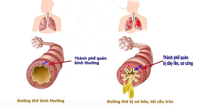 Viêm phế quản khó thở: Cơ chế và cách khắc phục