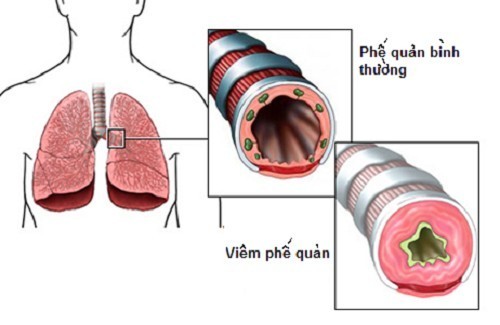 Viêm phế quản mạn tính: Nguyên nhân, triệu chứng