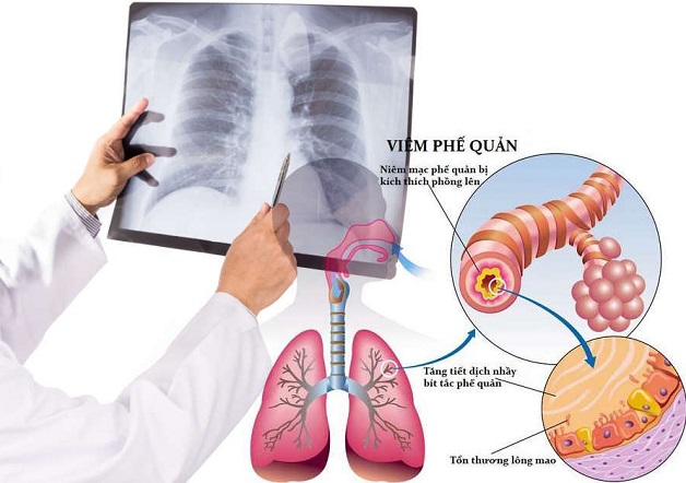 Viêm phế quản ở trẻ nhỏ: những điều cha mẹ cần biết