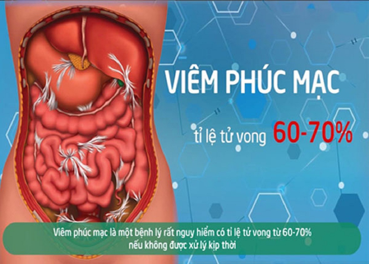 Viêm phúc mạc bệnh học: nguy cơ gây tử vong cao