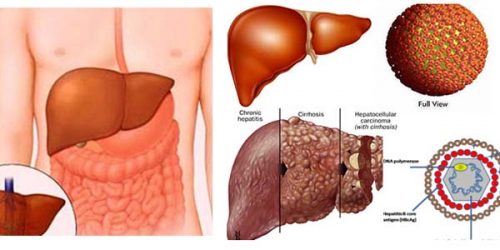 Viêm phúc mạc nhiễm khuẩn tiên phát