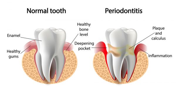 Viêm quanh cuống răng: Nguyên nhân, nhận biết, cách điều trị