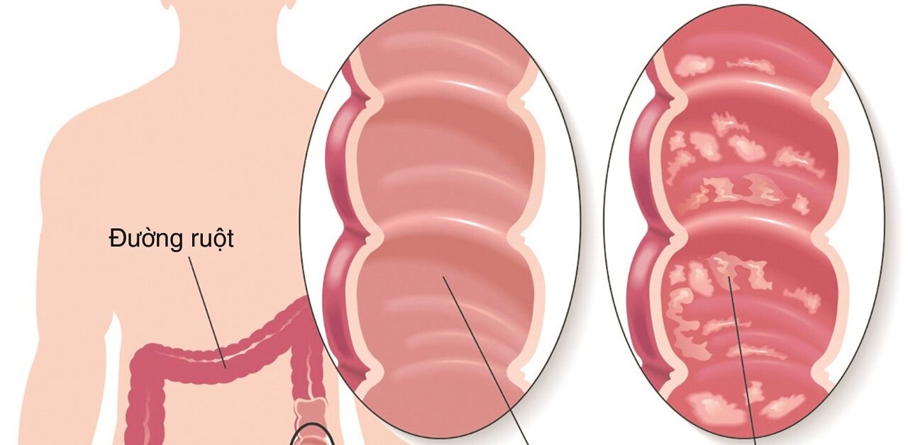 Viêm ruột cấp tính là gì? Nguyên nhân và cách điều trị