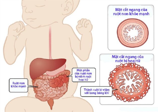 Viêm ruột hoại tử ở trẻ sơ sinh có nguy hiểm?