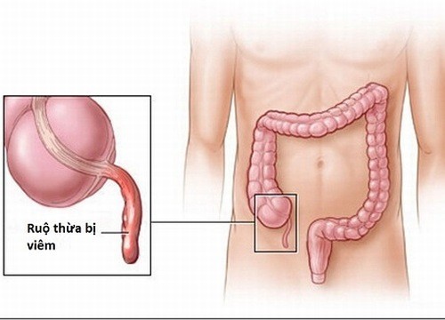 Viêm ruột thừa dấu hiệu nào cảnh báo?