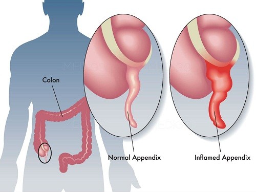 Viêm ruột thừa nguyên nhân do đâu?