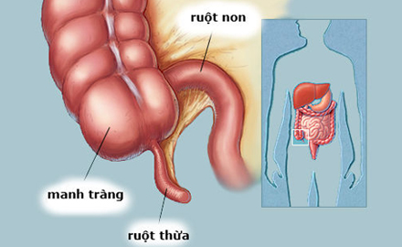 Viêm ruột thừa ở trẻ em biểu hiện và điều trị thế nào?