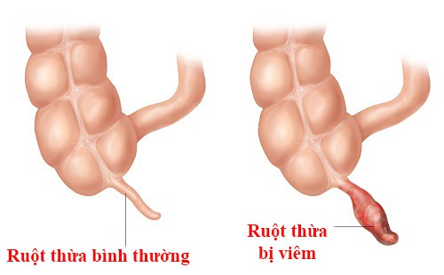 Viêm ruột thừa triệu chứng