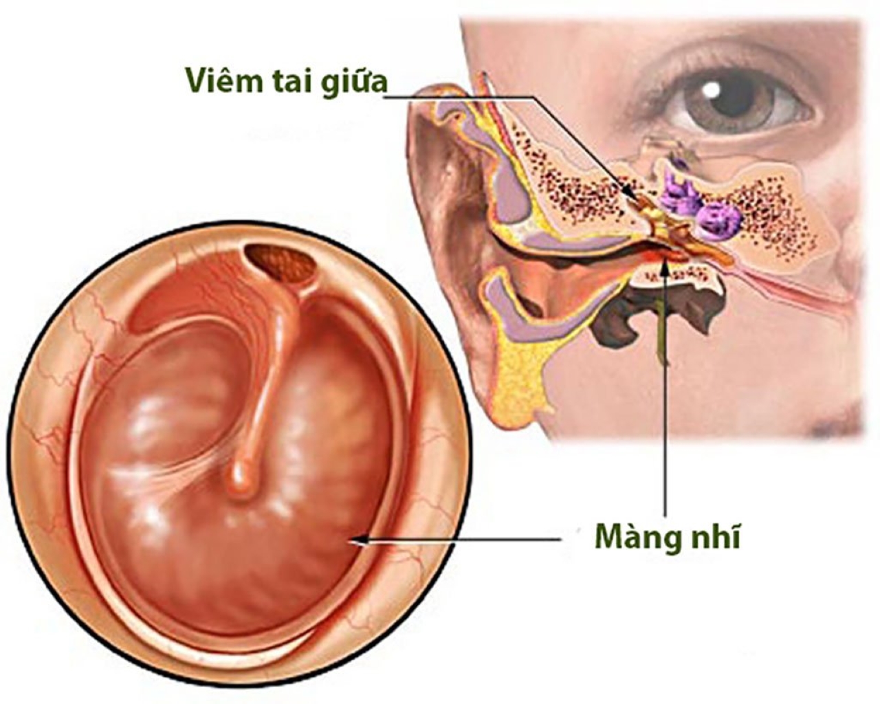 Viêm tai giữa mạn tính có nguy hiểm cho trẻ không?