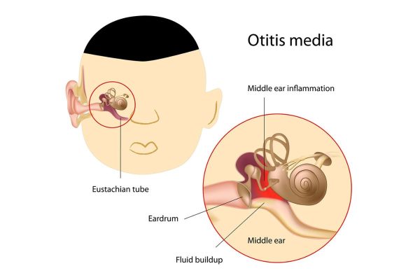 Viêm tai giữa ở trẻ em: Nguyên nhân, dấu hiệu, cách điều trị