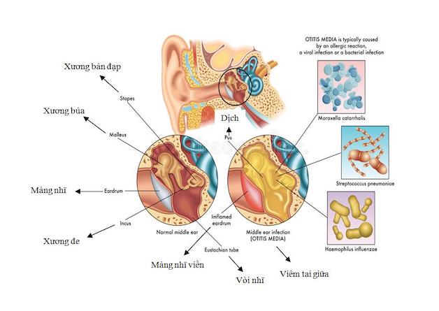 Viêm tai giữa trẻ em và những điều mẹ cần biết