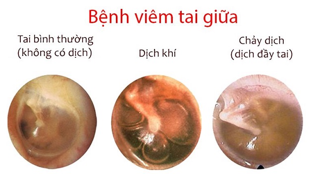 Viêm tai giữa trẻ sơ sinh: những điều cần biết 