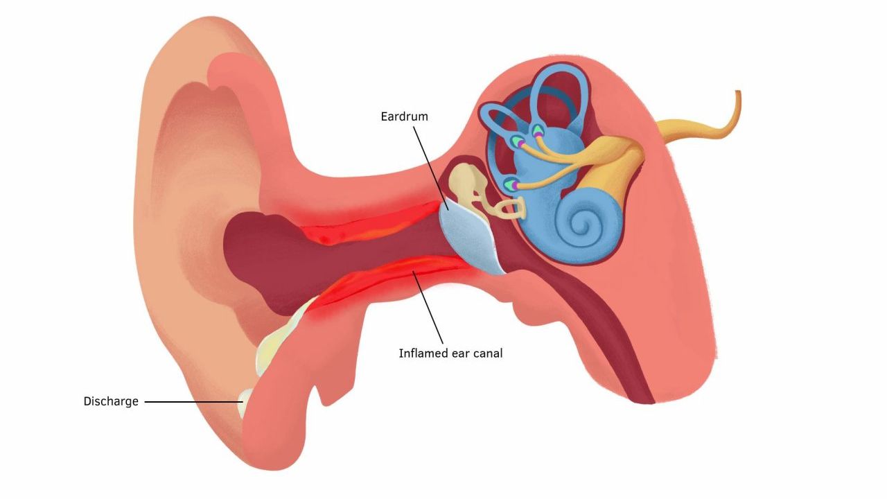 Viêm tai ngoài kiêng ăn gì? 5 thực phẩm cần tránh xa