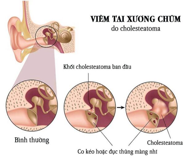 Viêm tai xương chũm có cholesteatoma – Bệnh lý nhiều nguy hiểm