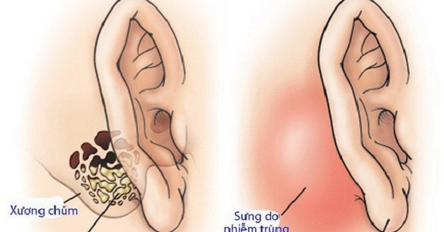 Viêm tai xương chũm có cholesteatoma – Bệnh lý nhiều nguy hiểm