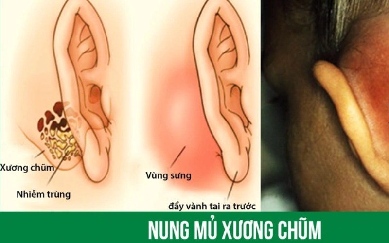 Viêm tai xương chũm gây biến chứng nguy hiểm nếu chủ quan