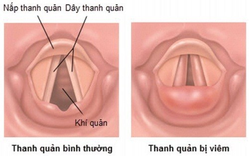 Viêm thanh quản cấp hay gặp trong mùa lạnh