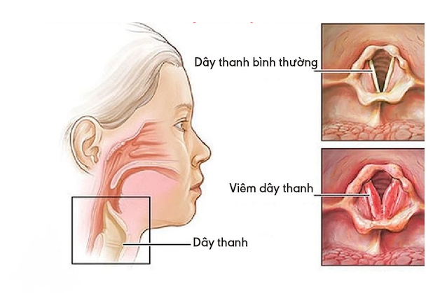 Viêm thanh quản mãn tính có điều trị được không?