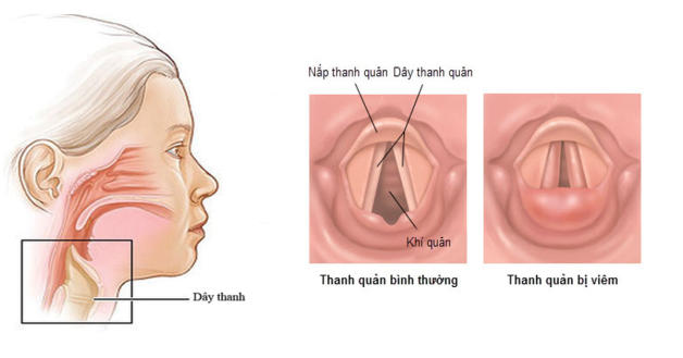 Viêm thanh quản uống thuốc gì để cải thiện bệnh tốt hơn?