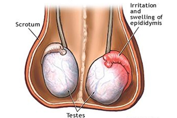 Viêm tinh hoàn sau quai bị bao lâu thì khỏi?