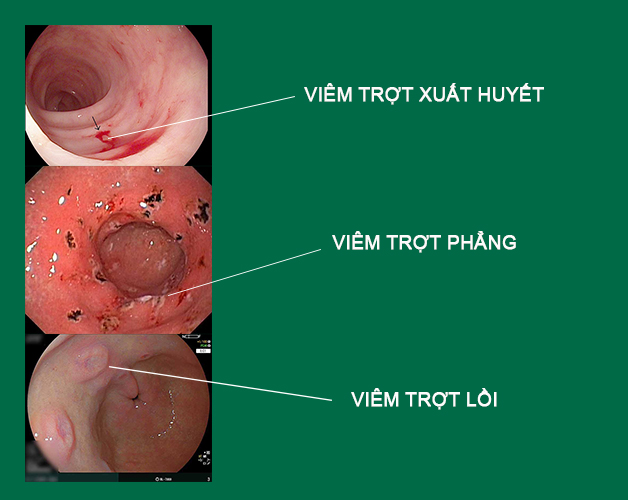 Viêm trợt niêm mạc hang vị dạ dày: Dấu hiệu và cách điều trị